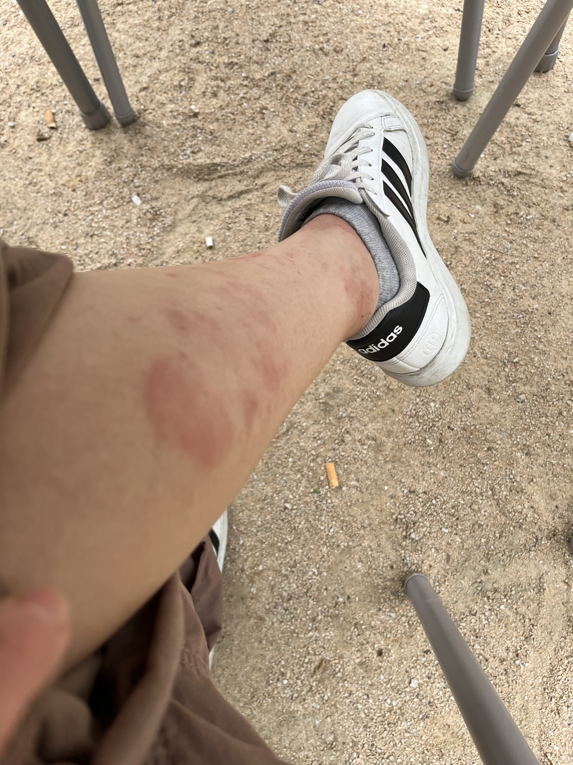 Dermatitis Atópica y Alergia alimentaria
